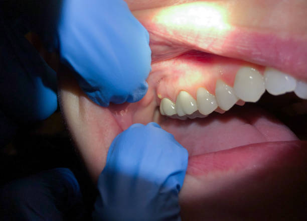 Best Teeth Whitening  in New City, NY